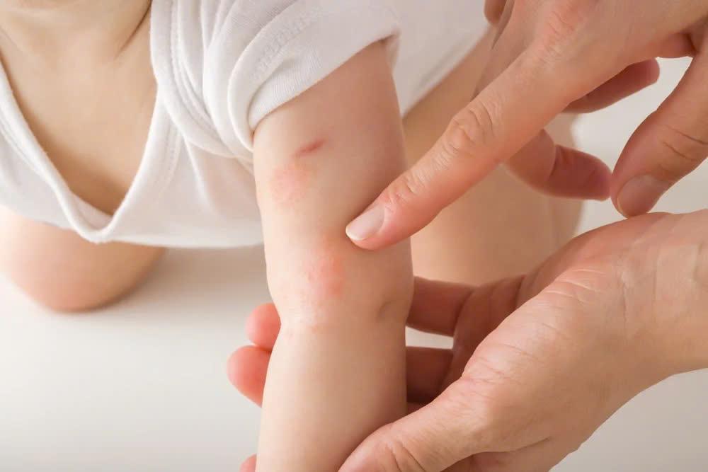 Cảnh báo mức độ nguy hiểm của dị ứng đạm sữa bò